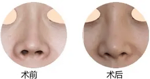 朝天鼻前后對(duì)比