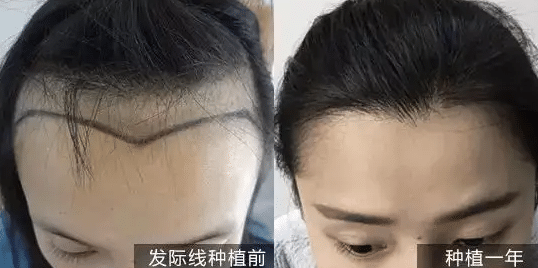 發(fā)際線種植前后對比