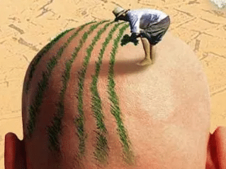 植發(fā)