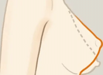 乳房下垂矯正