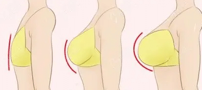自體脂肪隆胸