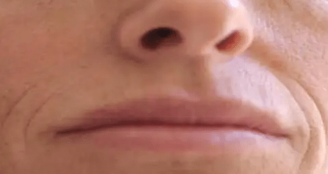 嘴角紋