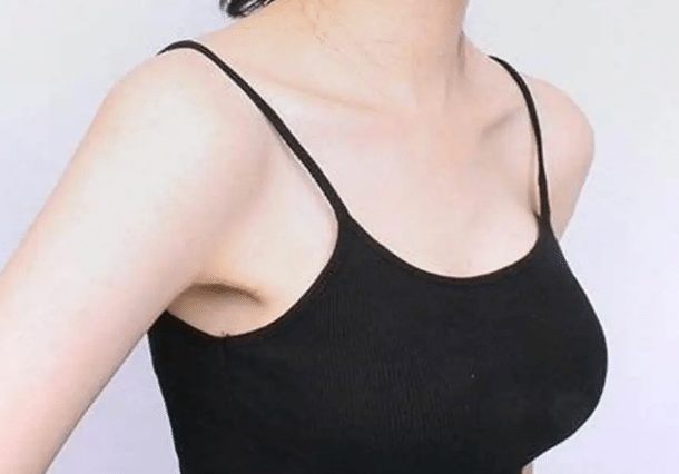 乳房下垂矯正多久消腫？術(shù)后需要注意什么？