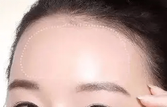 膨體豐額頭 膨體豐額頭