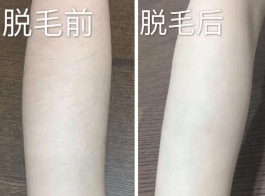 激光脫毛前后對(duì)比