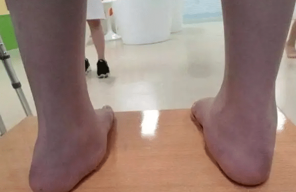 斷骨增高后遺癥