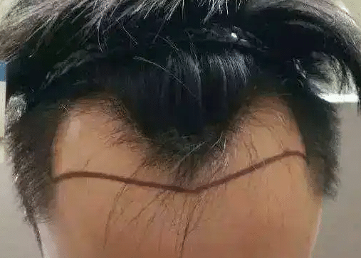 M型脫發(fā)
