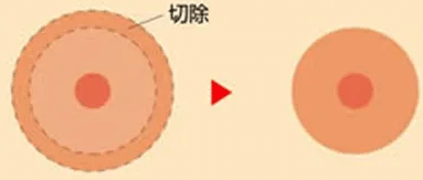 乳暈縮小效果怎么樣？一般可以保持多久呢？