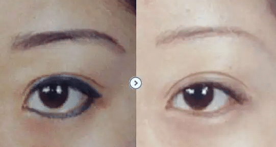 激光洗眉前后對比