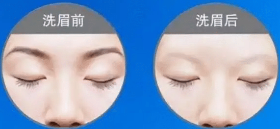 激光洗眉前后對(duì)比