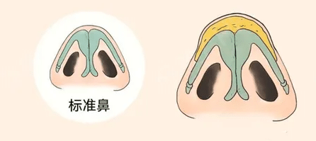 鼻頭縮小手術(shù)