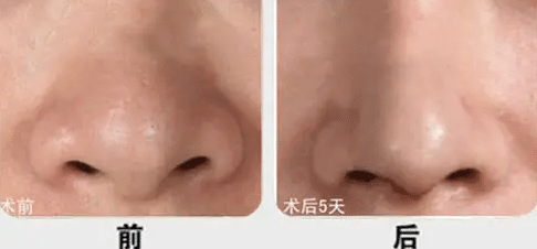 鼻頭縮小手術(shù)前后對(duì)比