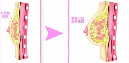 自體脂肪隆胸前后變化