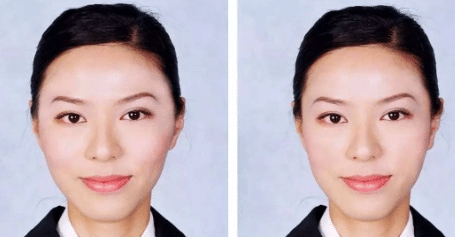 自體脂肪填充太陽穴前后對比 自體脂肪填充太陽穴前后對比