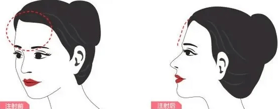 自體脂肪豐額頭