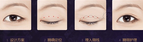 高分子壓雙眼皮