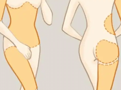 吸脂減肥
