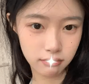 雙眼皮失敗修復(fù)