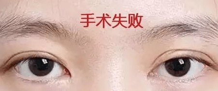 雙眼皮失敗