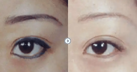 激光洗眉前后對(duì)比 激光洗眉前后對(duì)比
