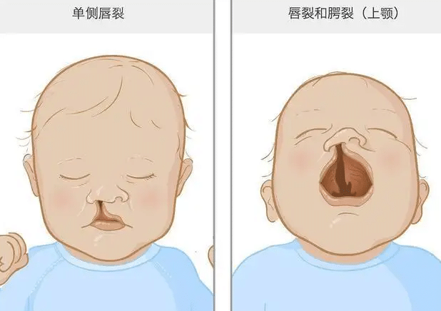 唇裂術(shù)后畸形修復(fù)的效果如何？出現(xiàn)疤痕該怎么辦？