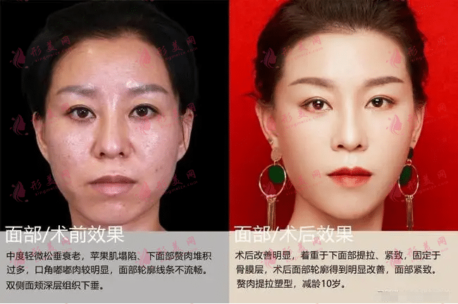 面部除皺適合哪些人，需要多少錢？