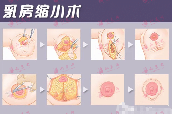 幾歲可以做乳房縮小手術?