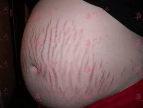 妊娠紋