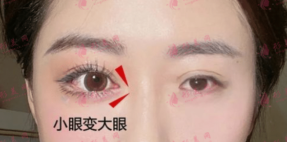開眼角拆線后洗臉需要注意什么?