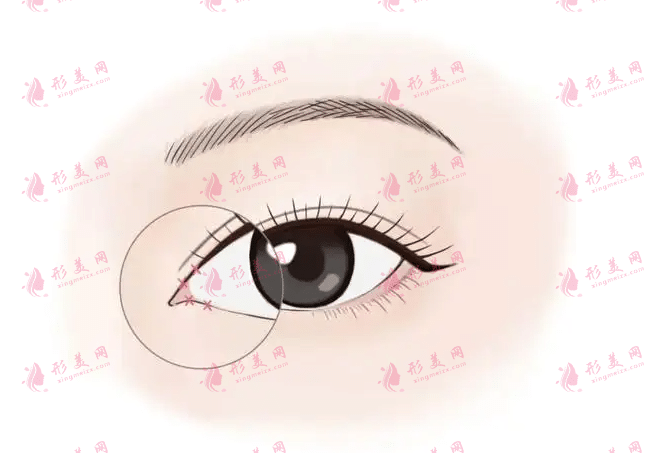 開眼角術(shù)后怎么護理?