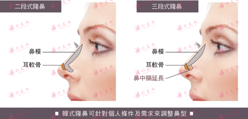 耳軟骨隆鼻會被吸收嗎?