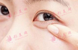 玻尿酸臥蠶填充