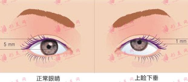 上瞼下垂