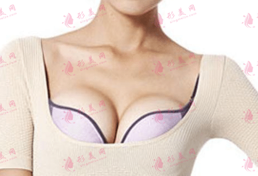 假體隆胸