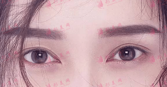 雙眼皮修復(fù)