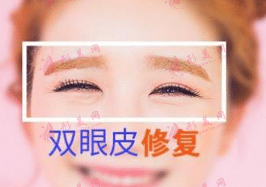 雙眼皮修復(fù)