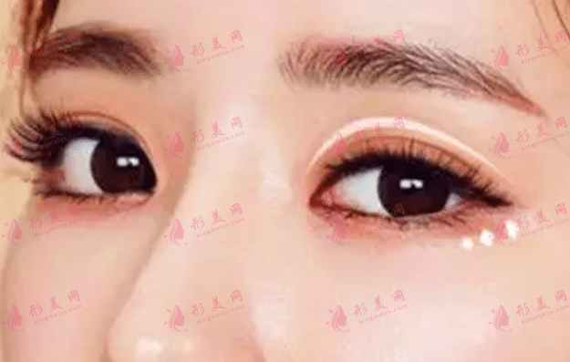 雙眼皮