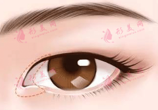 內(nèi)眼角