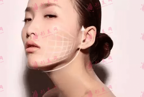 埋線提升