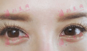 自體脂肪填充臥蠶