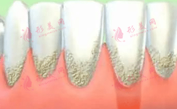 牙齦萎縮
