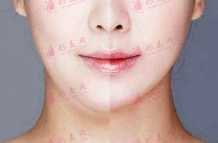 面部吸脂對比