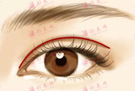 雙眼皮手術(shù)