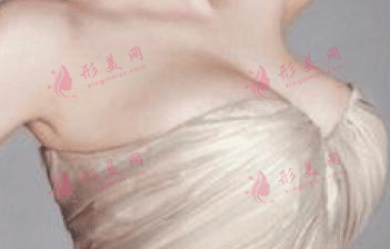 硅膠隆胸 硅膠隆胸