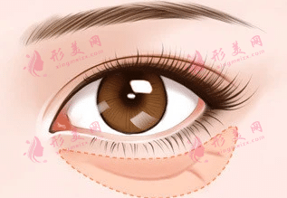 眶隔釋放釋放法
