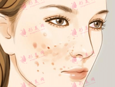 激光點(diǎn)痣 激光點(diǎn)痣