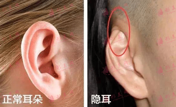 隱耳