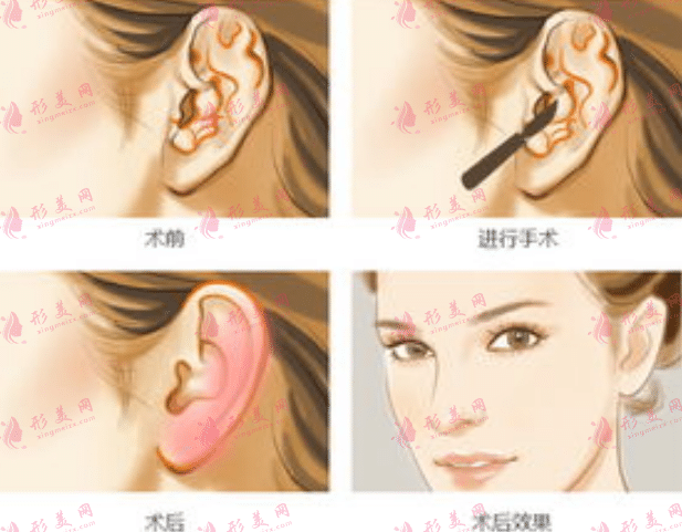 副耳矯正手術(shù)