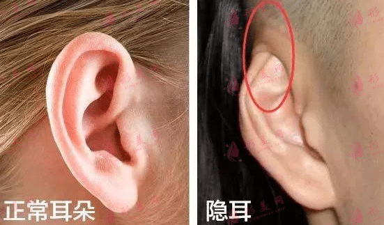 正常耳朵和隱耳的區(qū)別