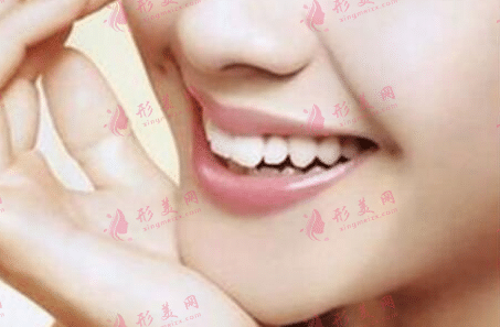 墊下巴 墊下巴